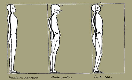 Posturologia - Disfunzione del sistema propriocettivo - Sidrome di deficienza posturale - Dislessia